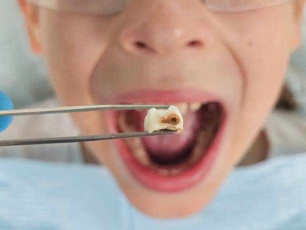 Best Knocked-Out Tooth (Avulsed Tooth) Treatment in Citrus, CA